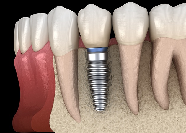 Illustration of dental implant fused with jawbone