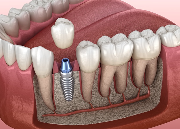 Illustration of dental crown being attached to dental implant