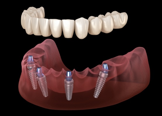 Illustrated full denture being placed onto four dental implants