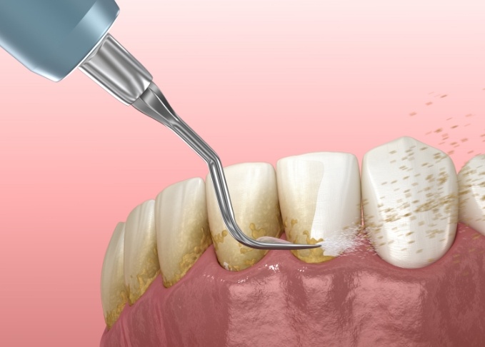 Illustrated dental instruments clearing plaque from teeth during gum disease treatment