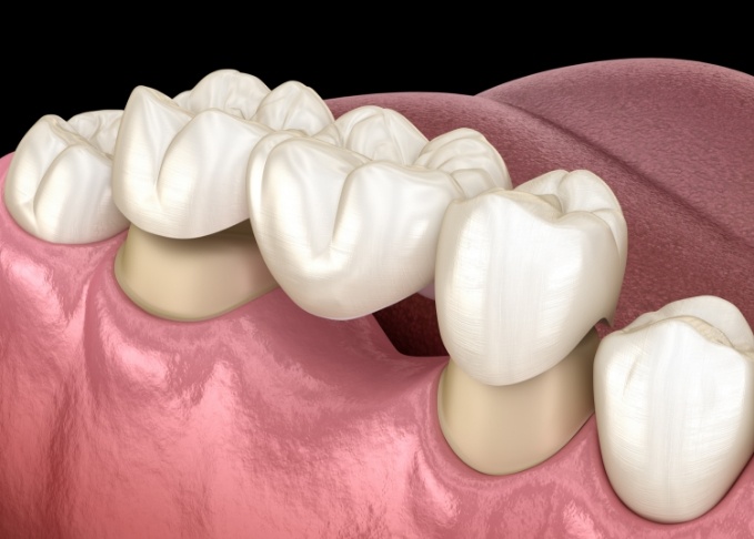 Illustrated dental bridge replacing a missing tooth