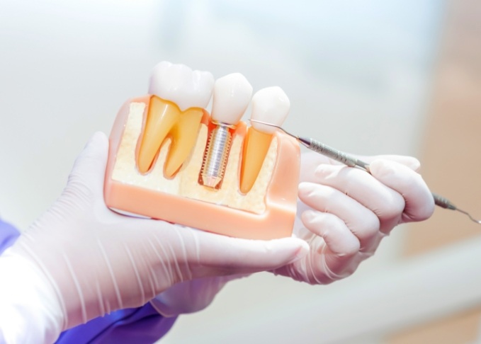 Dentist holding a model of a dental implant