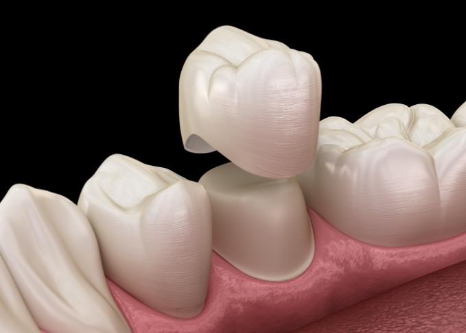 Illustrated dental crown being placed over a tooth