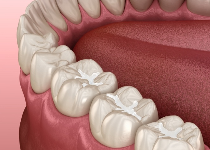 Illustrated row of teeth with white fillings