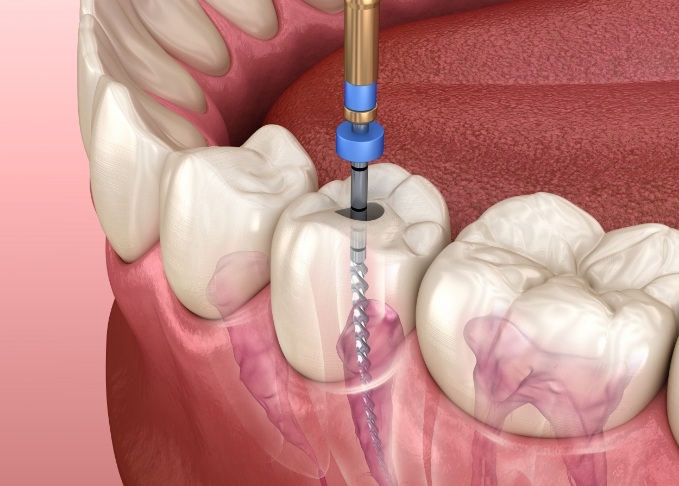 Illustrated dental instrument cleaning inside a tooth during root canal treatment