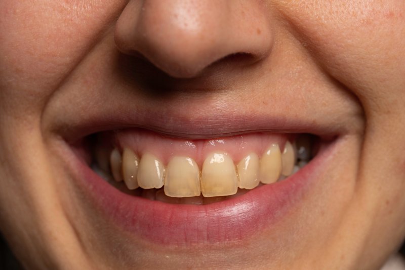A closeup of a smile with deep tooth stains