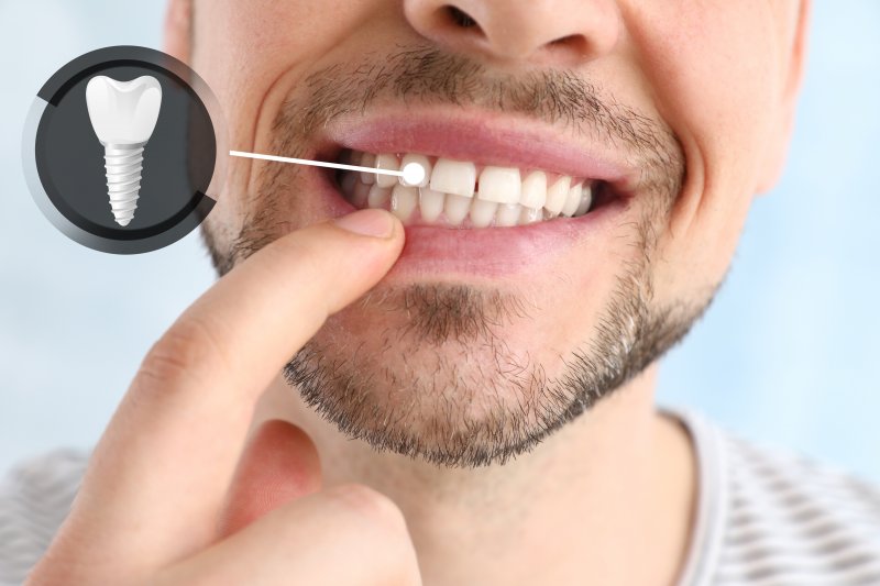 A patient pointing out his new dental implant